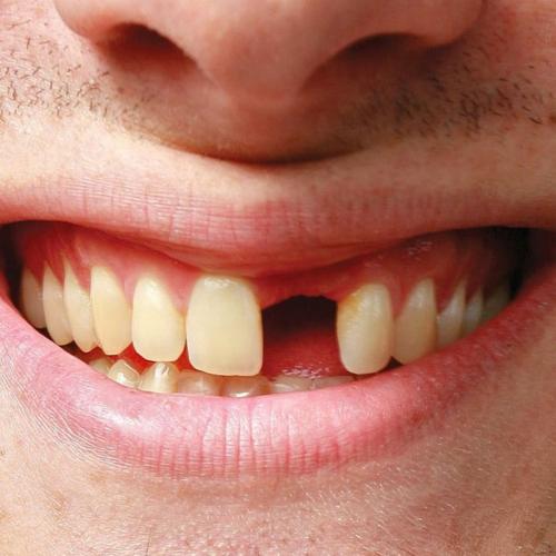 Незабываемый опыт: фальшивый стоматолог вырвал у пациента четыре передних зуба