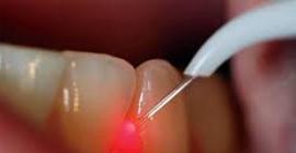 Новые технологии в стоматологии - лазер вместо бормашины