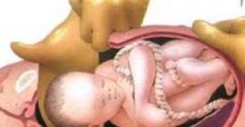 Иммунитет новорожденного снижает кесарево сечение