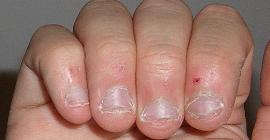 Ученые из канадского университета Макмастера назвали привычку грызть ногти полезной