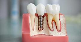 Врач-стоматолог Андрей Елизаров рассказал о плюсах и минусах зубной имплантологии