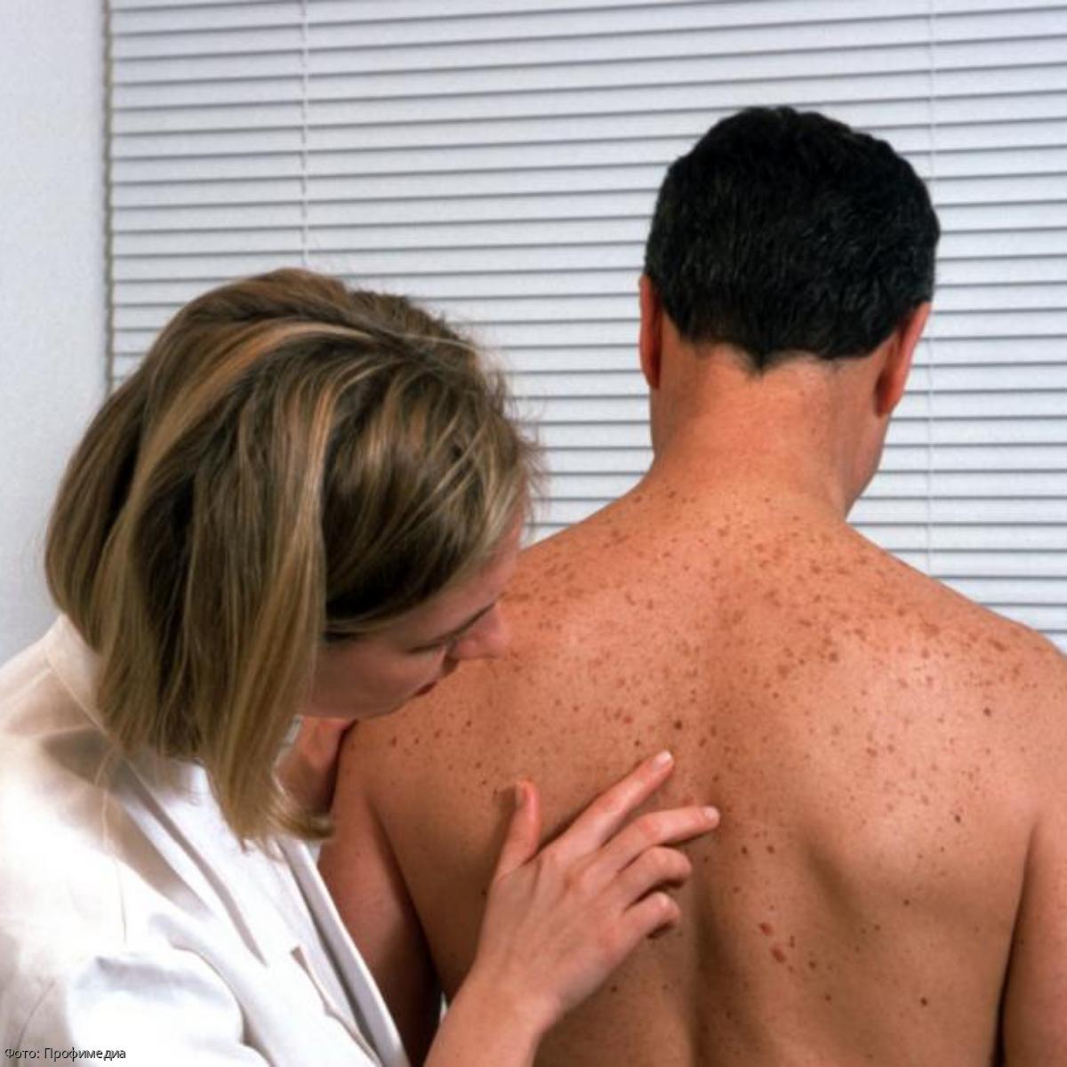 онкологические заболевания кожи фото