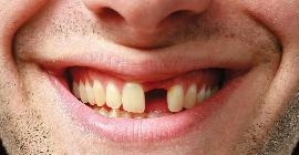 Незабываемый опыт: фальшивый стоматолог вырвал у пациента четыре передних зуба