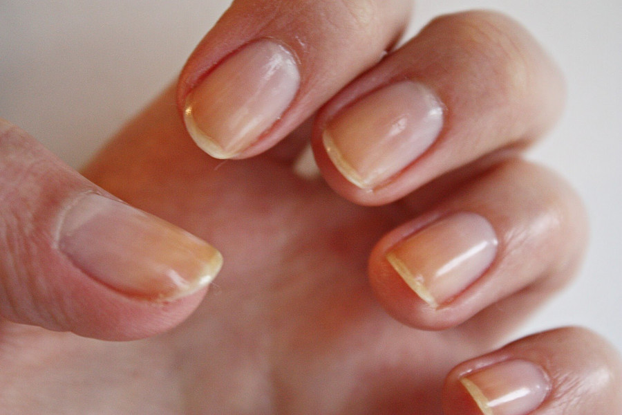 желтые пятна на ногтях