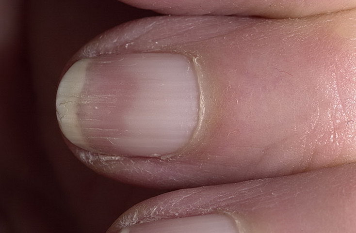 Ногтевые форум. Половинчатые ногти Терри. Онихорексис онихомикоз. Нормотрофический онихомикоз. Ониходистрофия (дистрофия ногтей).
