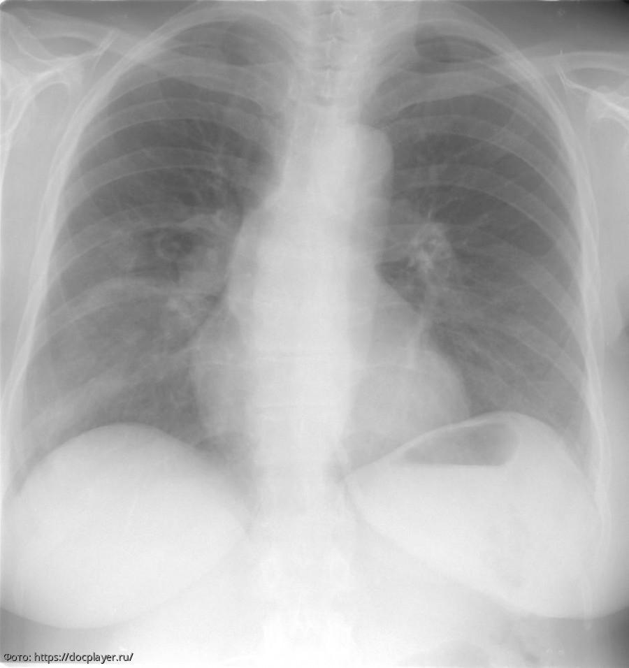 Снимок больного липоидной пневмонией