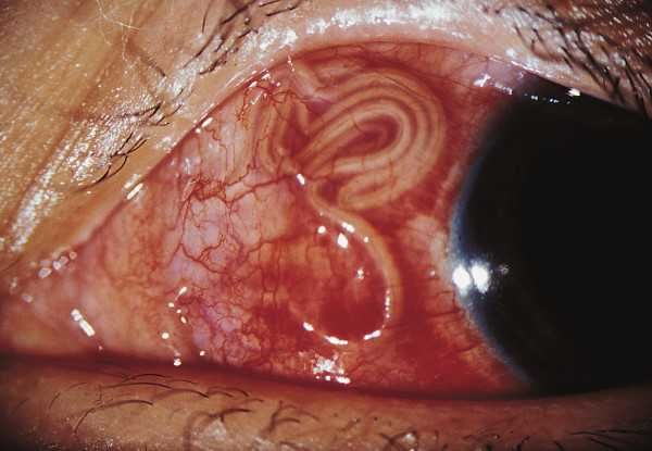дирофиляриоз глаз человека